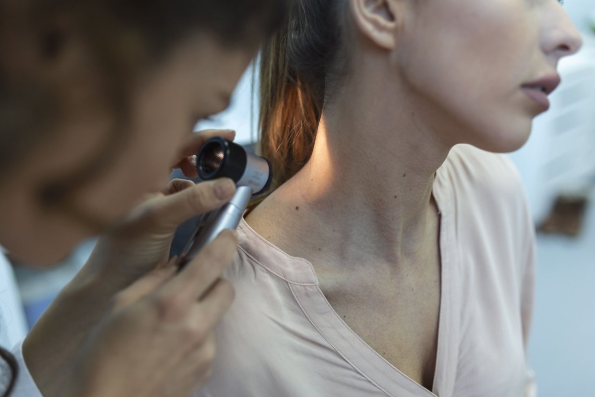 Como prevenir o melanoma cutâneo