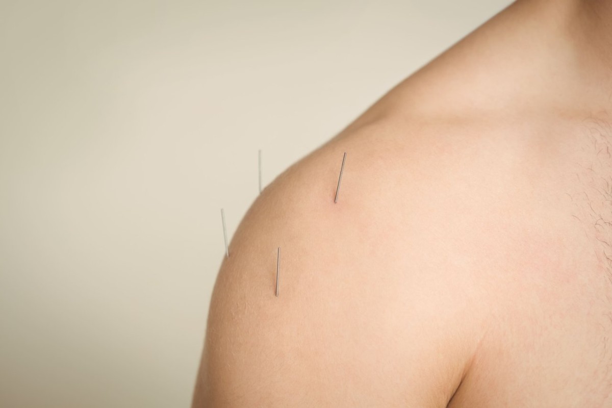 Você já ouviu falar em Dry Needling?