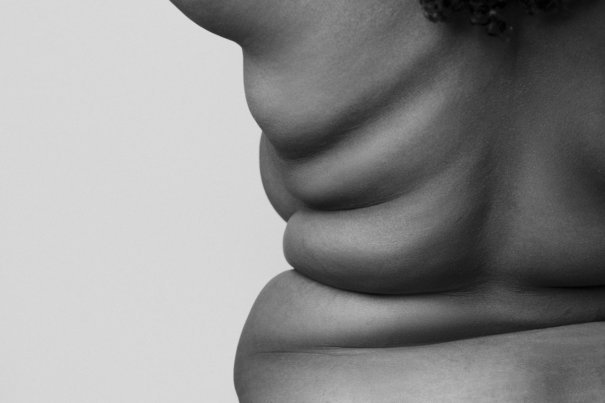 Obesidade e Cirurgia Bariátrica