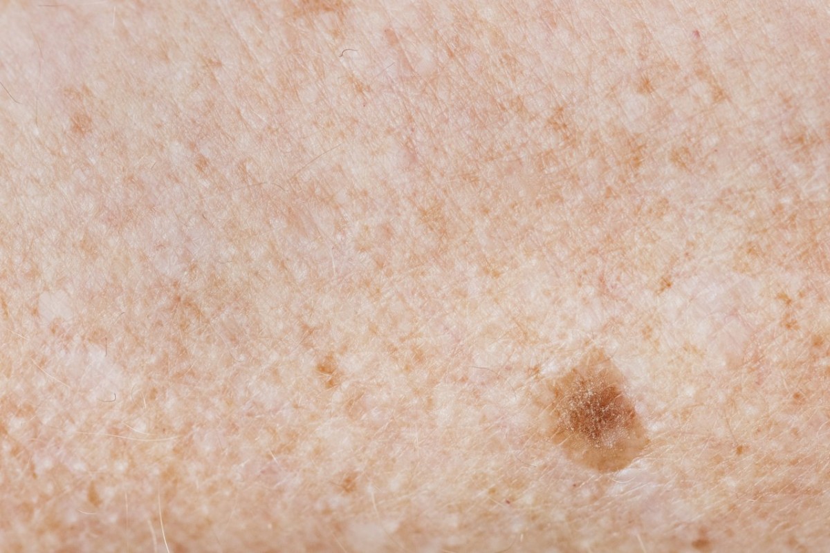 Carcinoma Espinocelular - O mais grave?