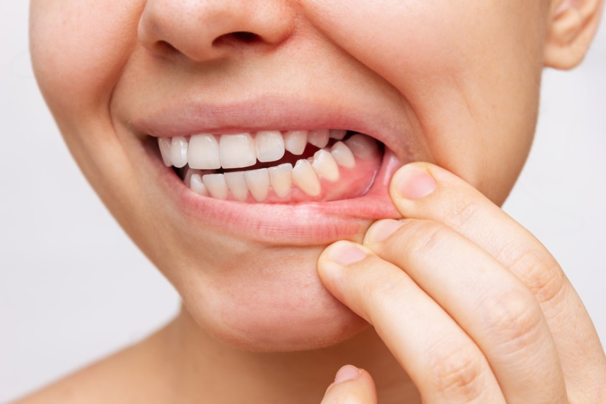 10 Dicas para cuidar da sua gengiva