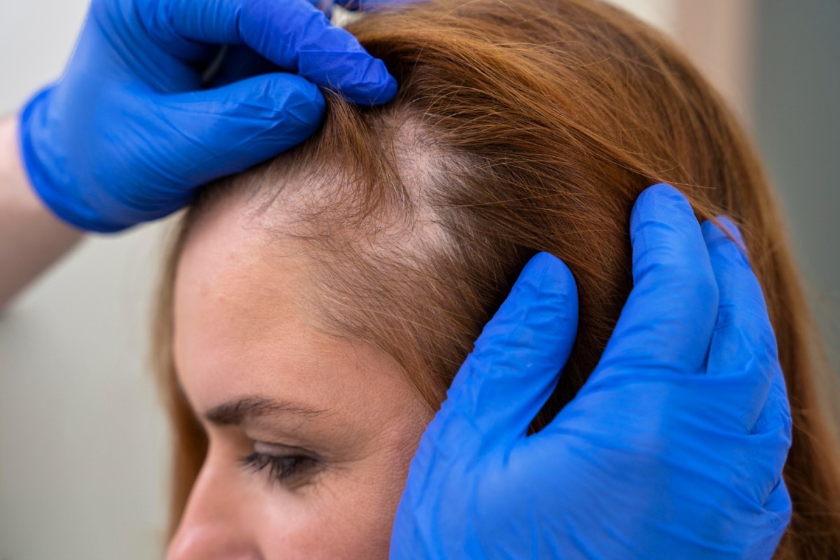 Alopecia Androgenética: A condição capilar que afeta celebridades e pessoas comuns