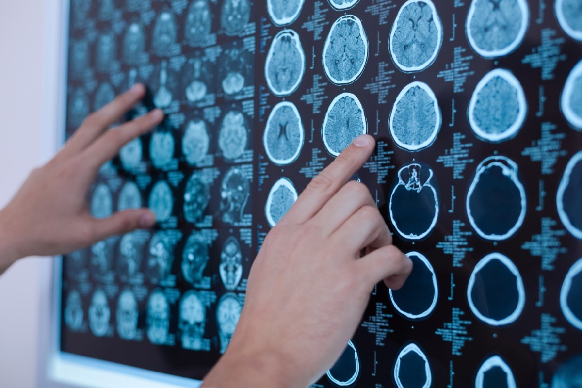 Parkinson ou não? Médico alerta para doença tratável que imita os sintomas do Parkinson