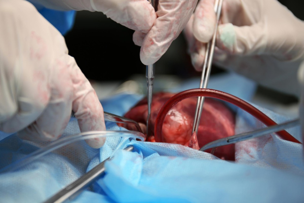 Transplante de Fígado: Quando Deixa de Ser Escolha e Se Torna a Única Alternativa para Viver