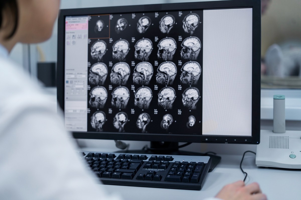 Maio Cinza: Diagnóstico Precoce é Fundamental no Combate aos Tumores Cerebrais