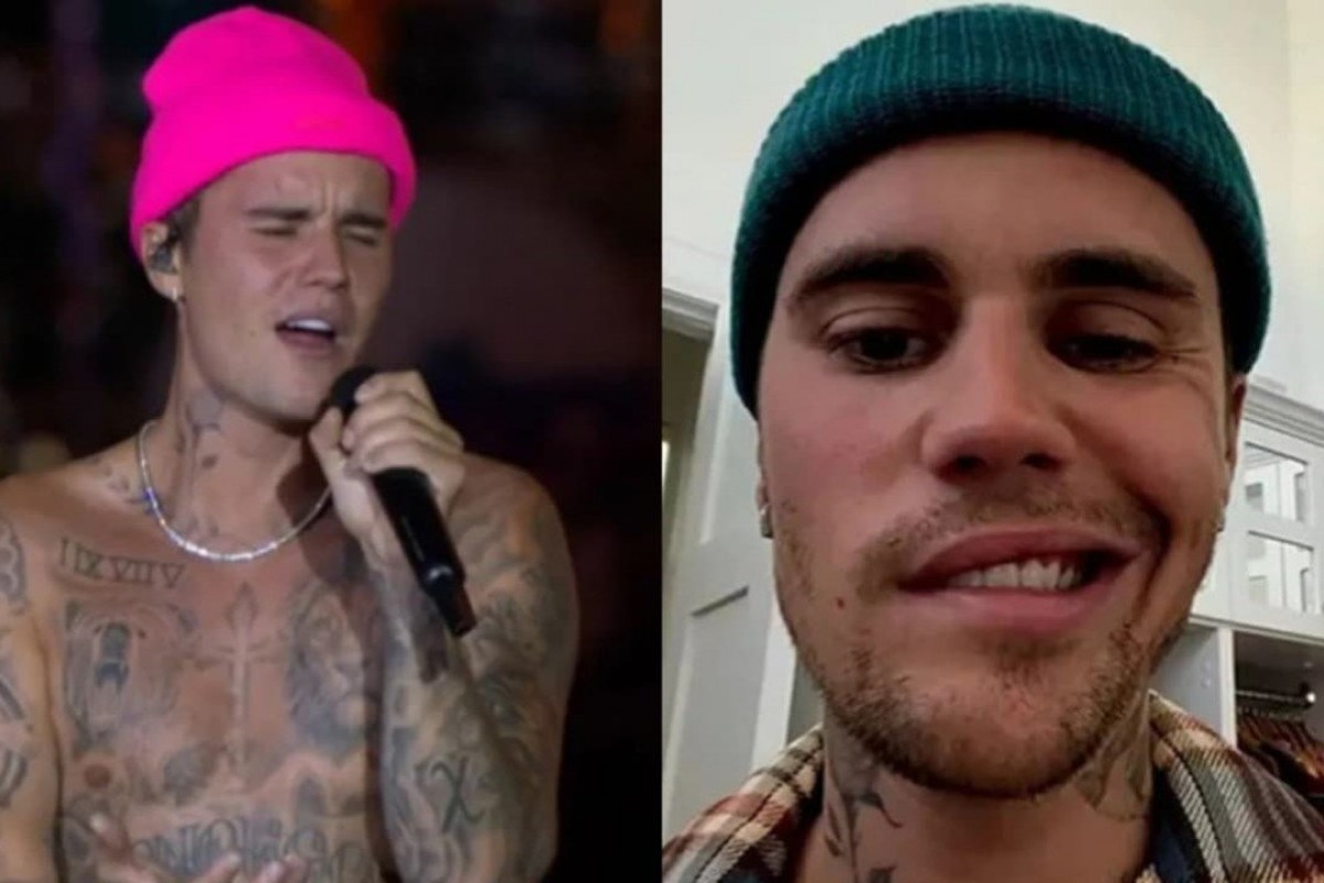Entenda a síndrome que causou paralisia no rosto do cantor Justin Bieber