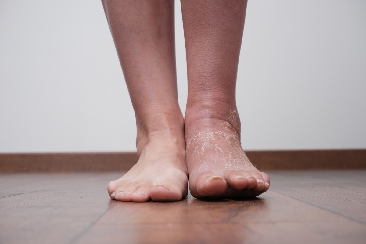 Pés e tornozelos inchados: quando o desconforto pode ser um alerta?