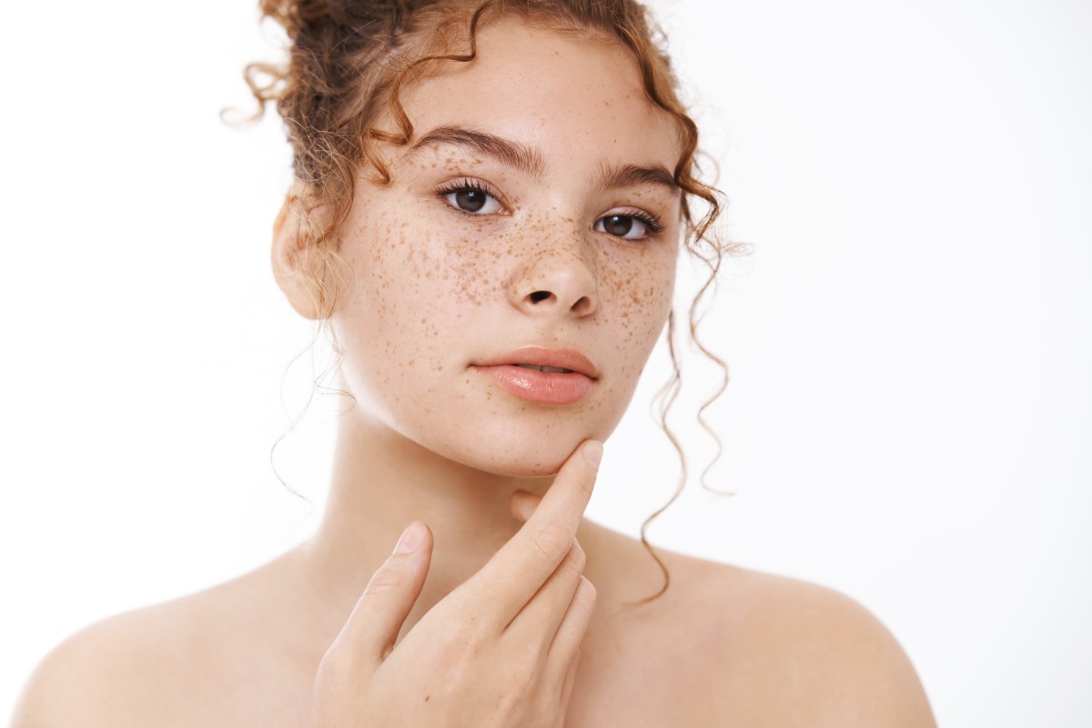 Manchas e melasma no verão: saiba como prevenir e tratar para manter sua pele saudável