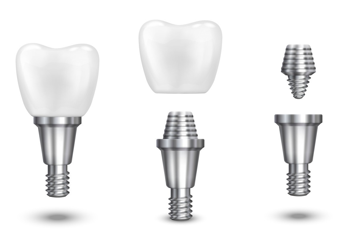 Implantes dentários: tecnologia que transforma sorrisos e revoluciona a odontologia