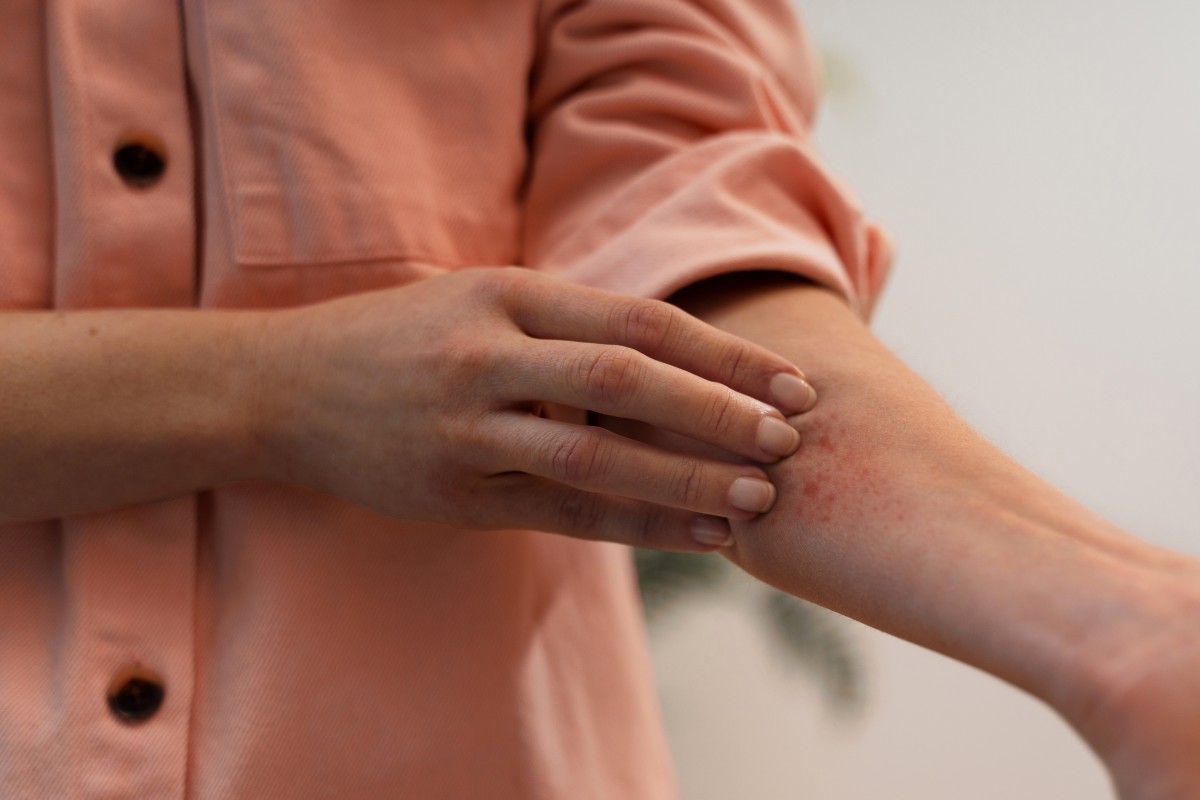 Como prevenir e agir em casos de reação alérgica a picadas de insetos