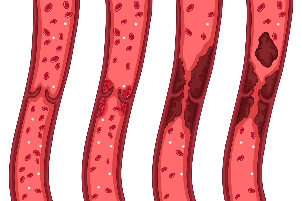 Nutrição e doenças vasculares: como a alimentação ajuda a prevenir a aterosclerose