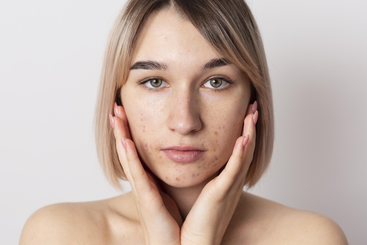 Como tratar cicatrizes de acne e melhorar a saúde da pele