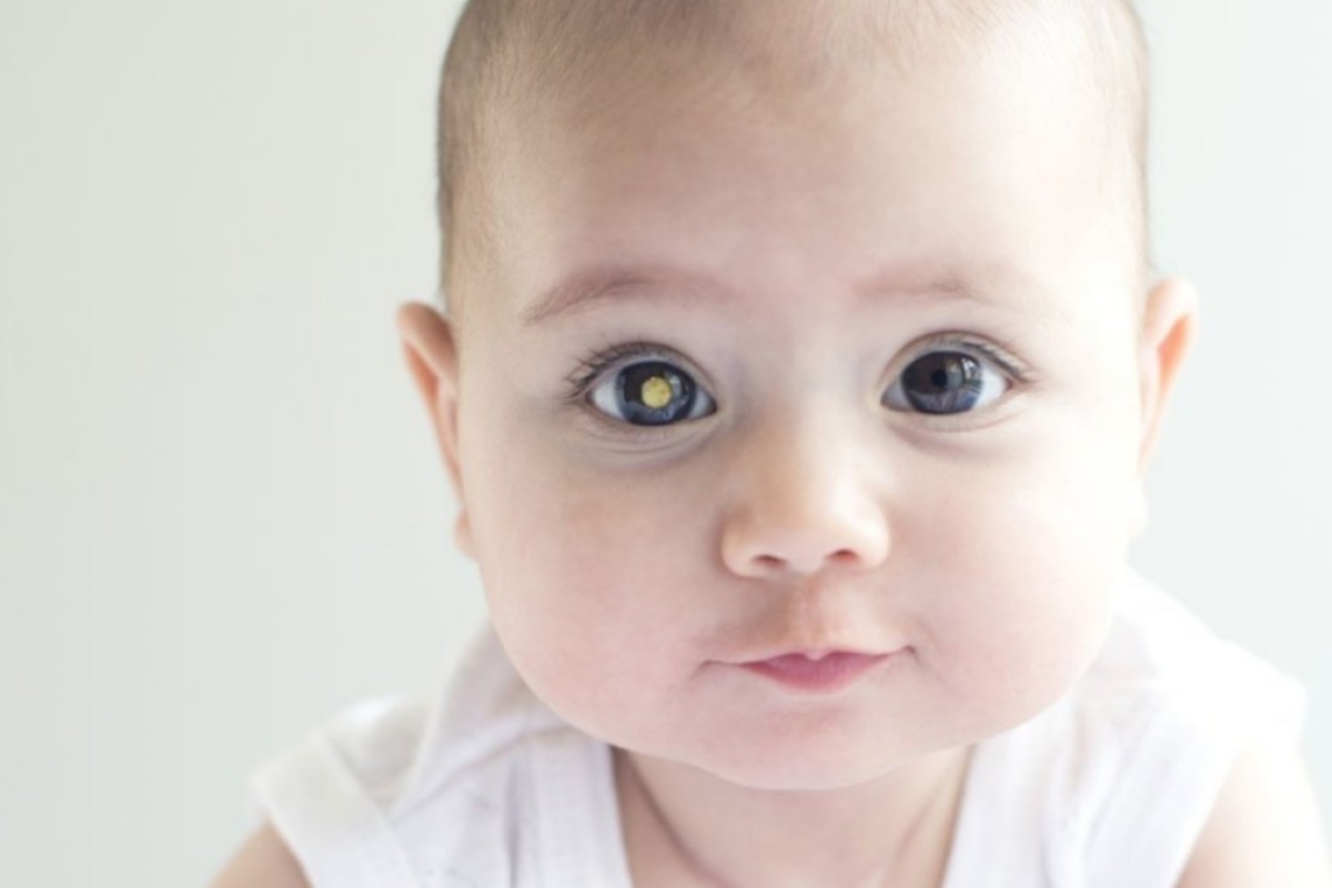 Retinoblastoma infantil: reflexo esbranquiçado nos olhos pode indicar tumor raro