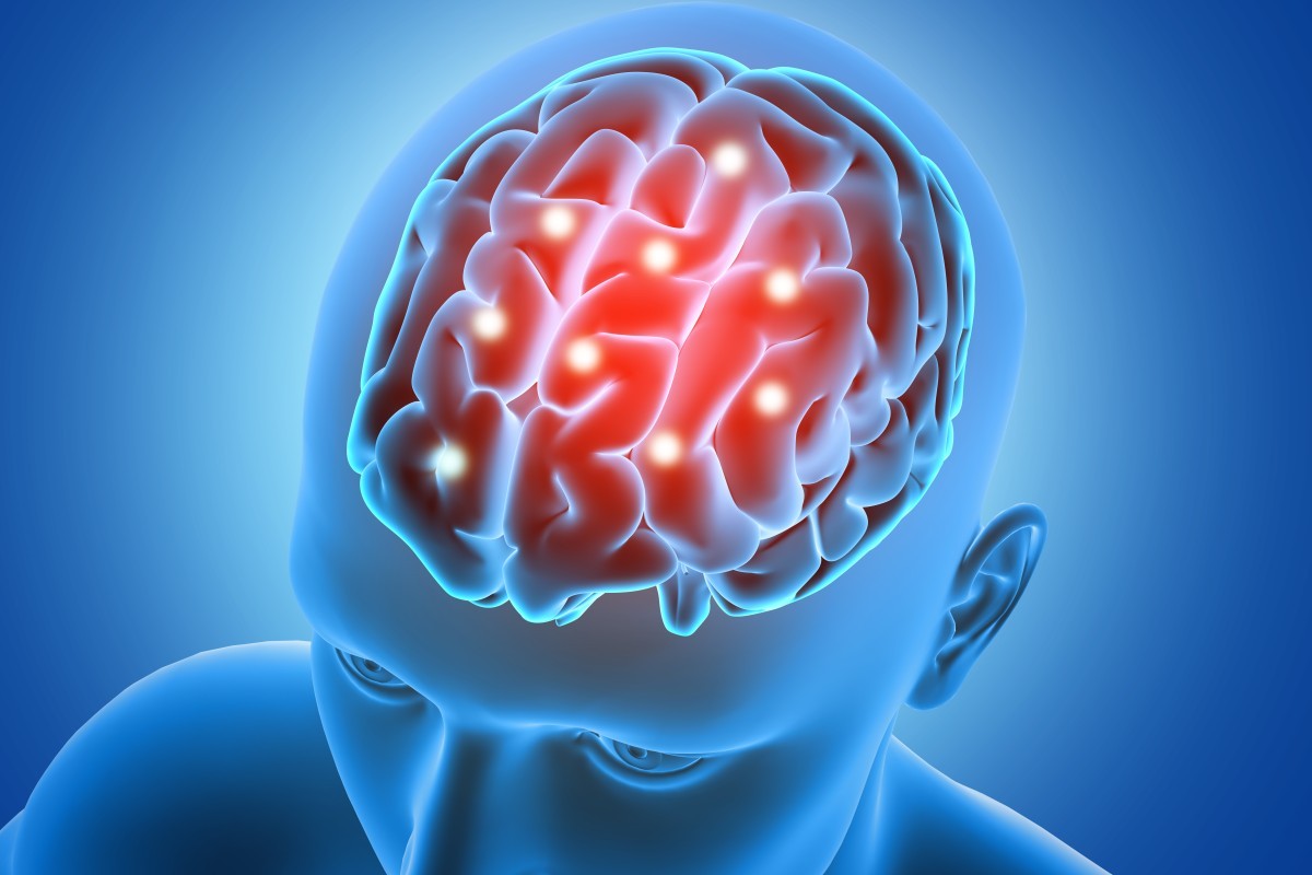 Estimulação Cerebral Profunda: A Nova Esperança para Pacientes com Epilepsia Refratária!