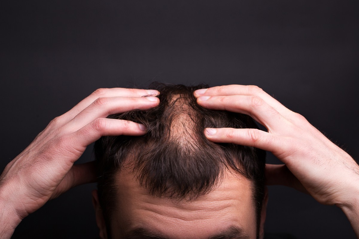 Alopecia Androgenética: Causas, Sintomas e Novas Opções de Tratamento para a Calvície