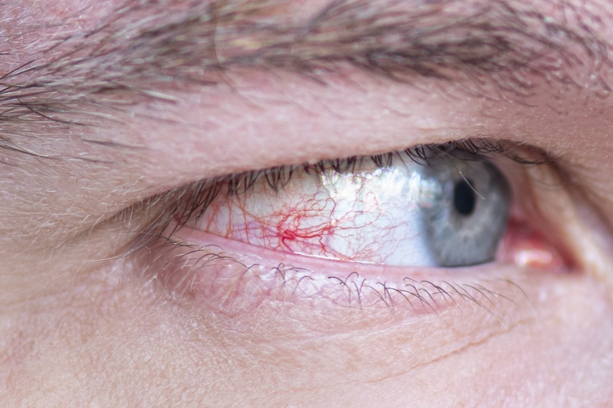 Cuidados com os Olhos no Carnaval: Como Evitar Irritações e Infecções Oculares