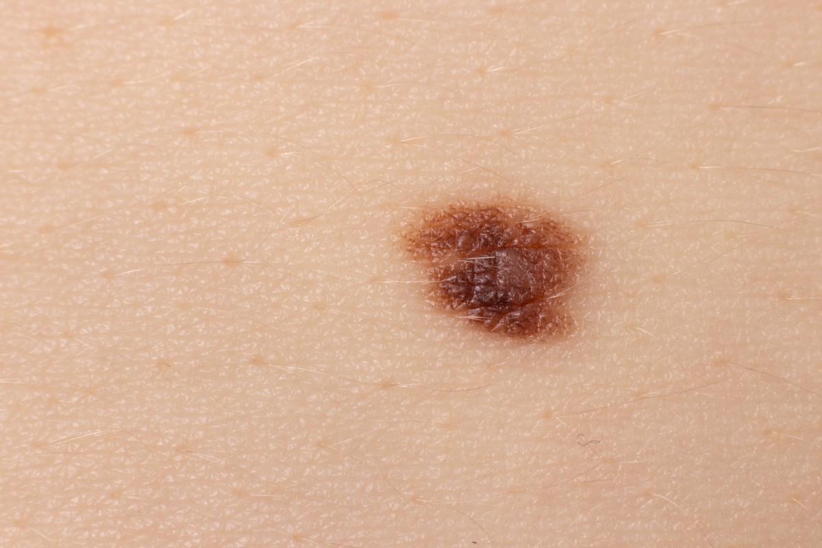 Câncer de Pele em Crianças: Sinais de Alerta e Dicas de Prevenção