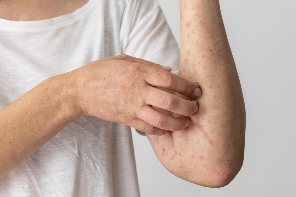 Doenças Raras: Avanços no Diagnóstico e Tratamento da Epidermólise Bolhosa e Xeroderma Pigmentos