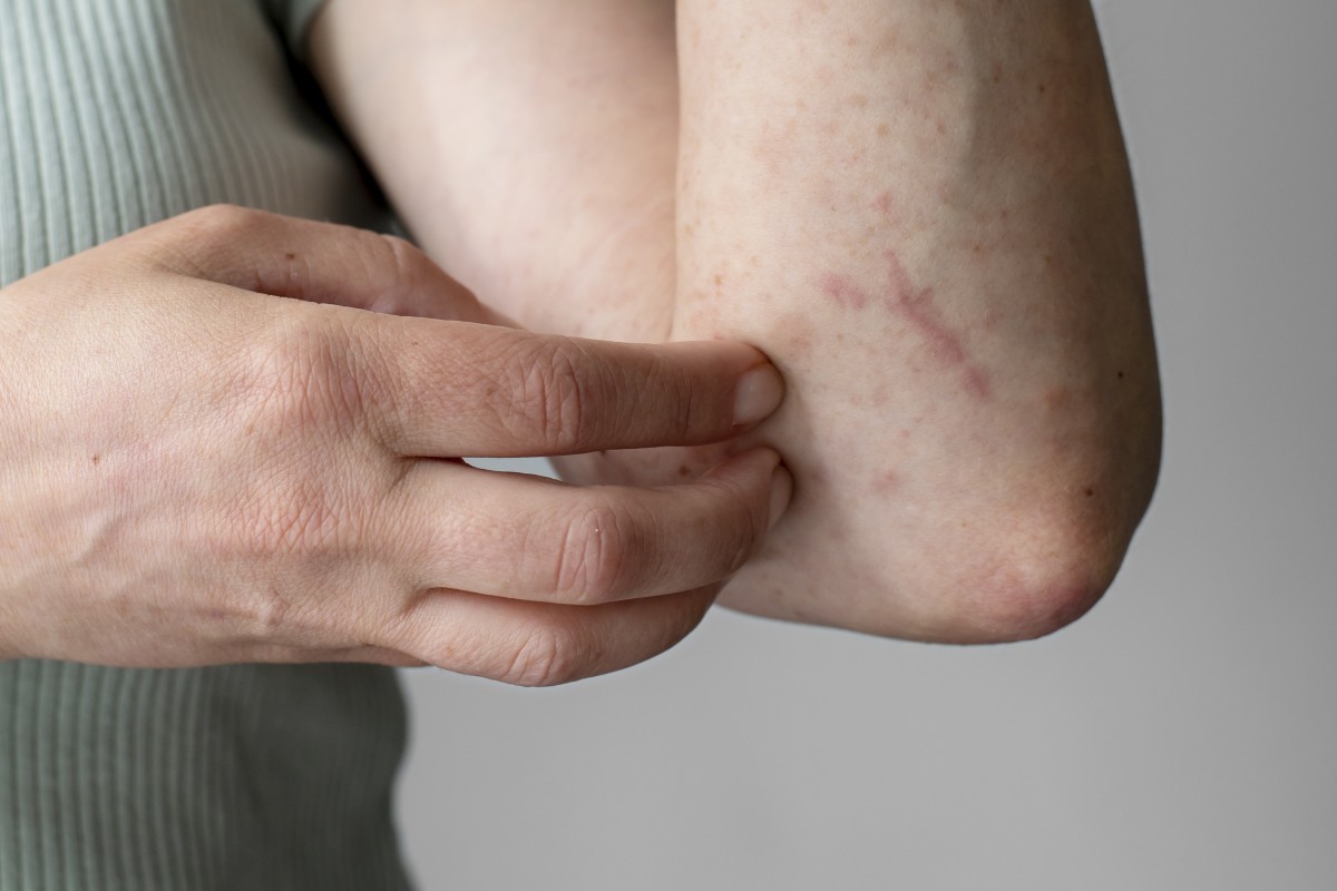 Herpes Zoster: Doença Comum Pode Causar Dores Intensas e Complicações Severas