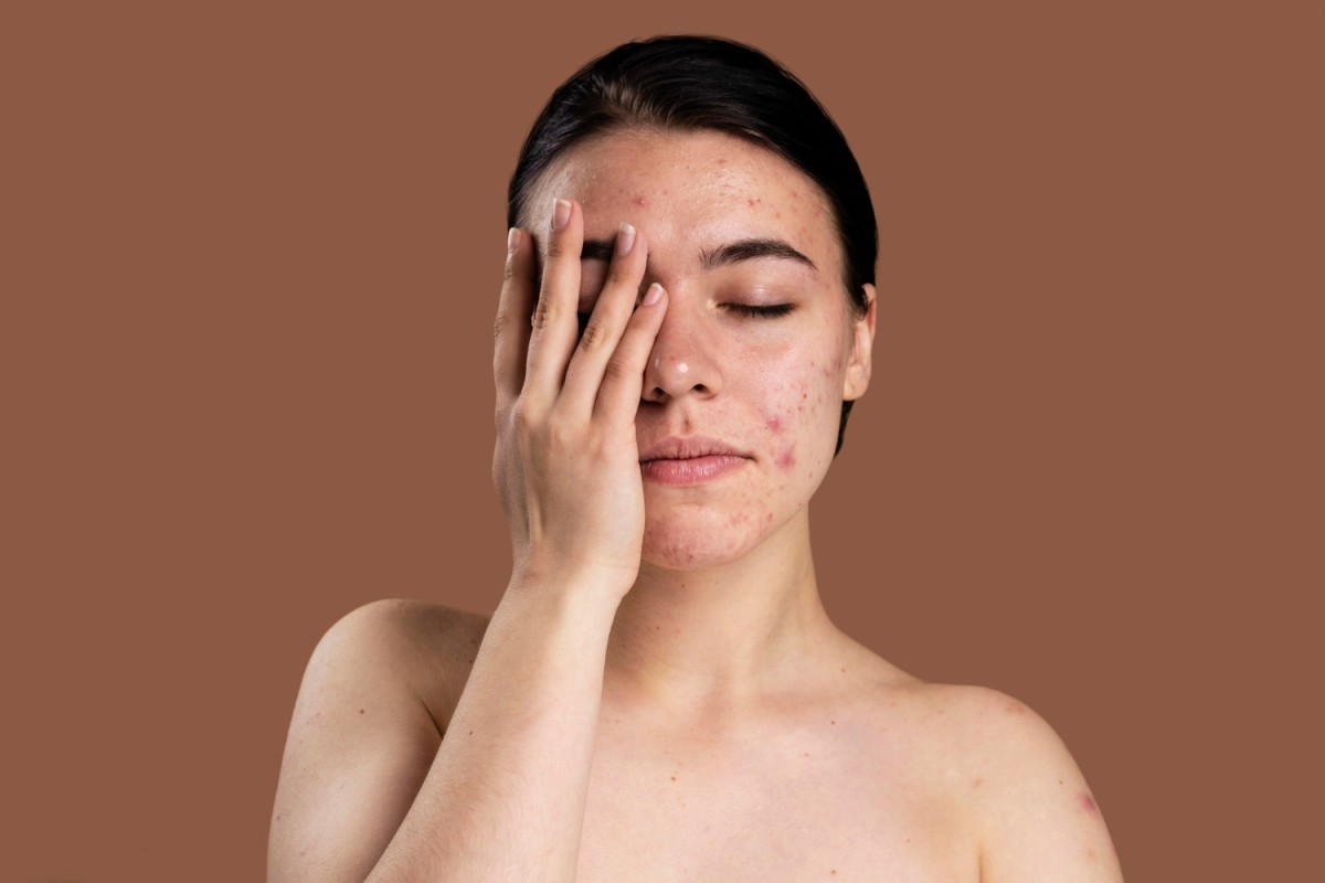 Dia da Mulher: Desafios no Tratamento de Acne e Melasma