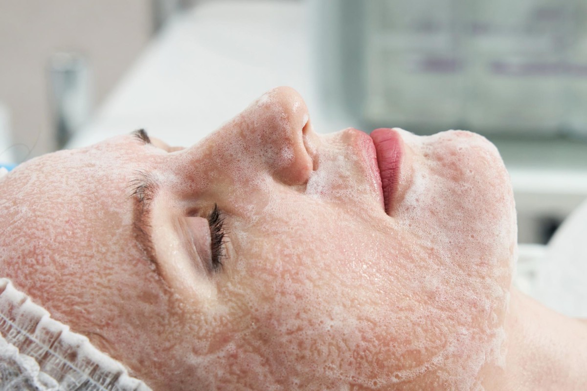 Peeling Químico: Dicas para um Procedimento Seguro e com Resultados Eficazes