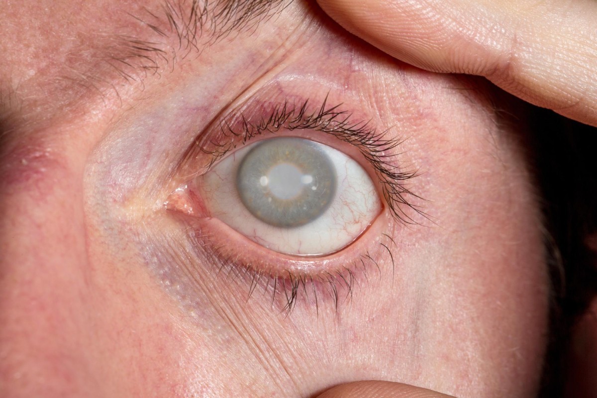 Ansiedade e Depressão em Pacientes com Glaucoma