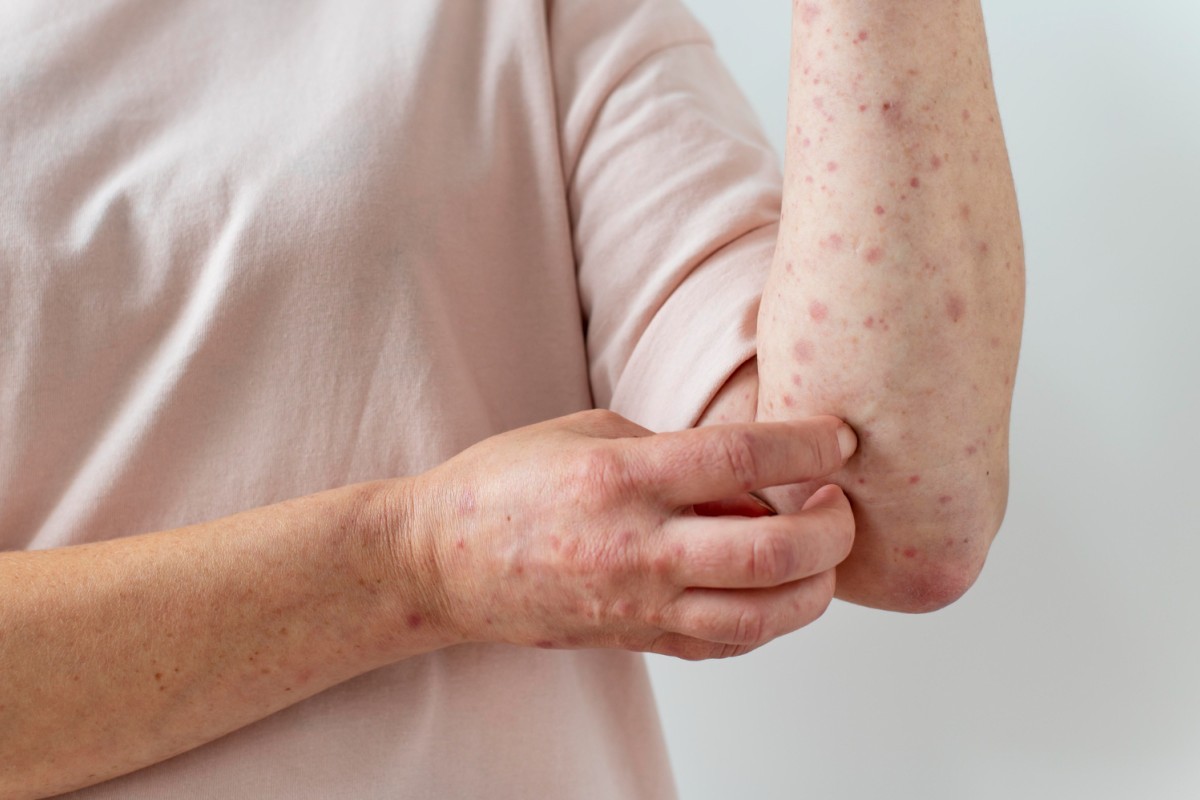 Sarampo Volta a Preocupar no Brasil: Vacinação é Essencial para Prevenir Surtos