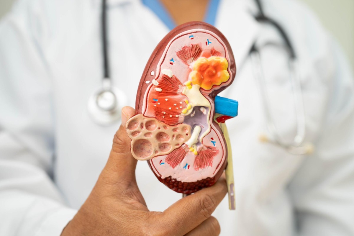 Câncer Renal: Tumor Silencioso e Perigoso que Geralmente Só Dá Sinais em Estágios Avançados