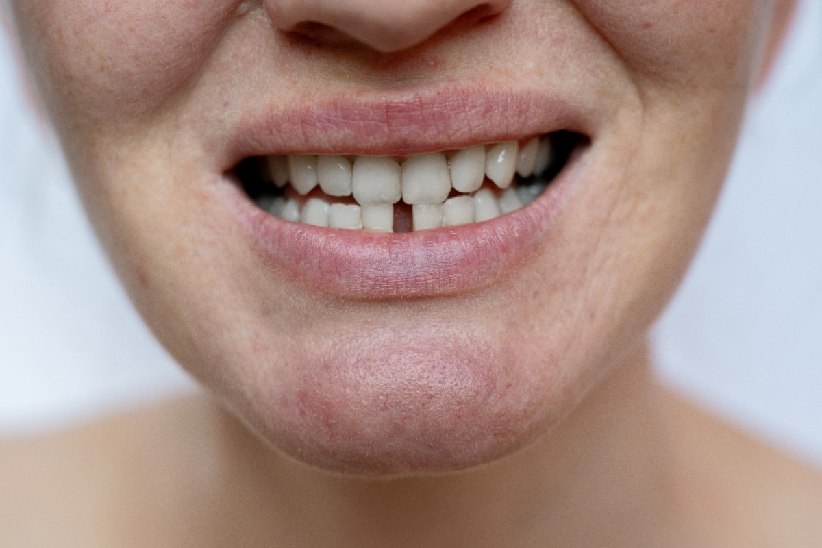 Perdeu ou Quebrou um Dente? Saiba Como Agir nos Primeiros Minutos para Salvar Seu Sorriso