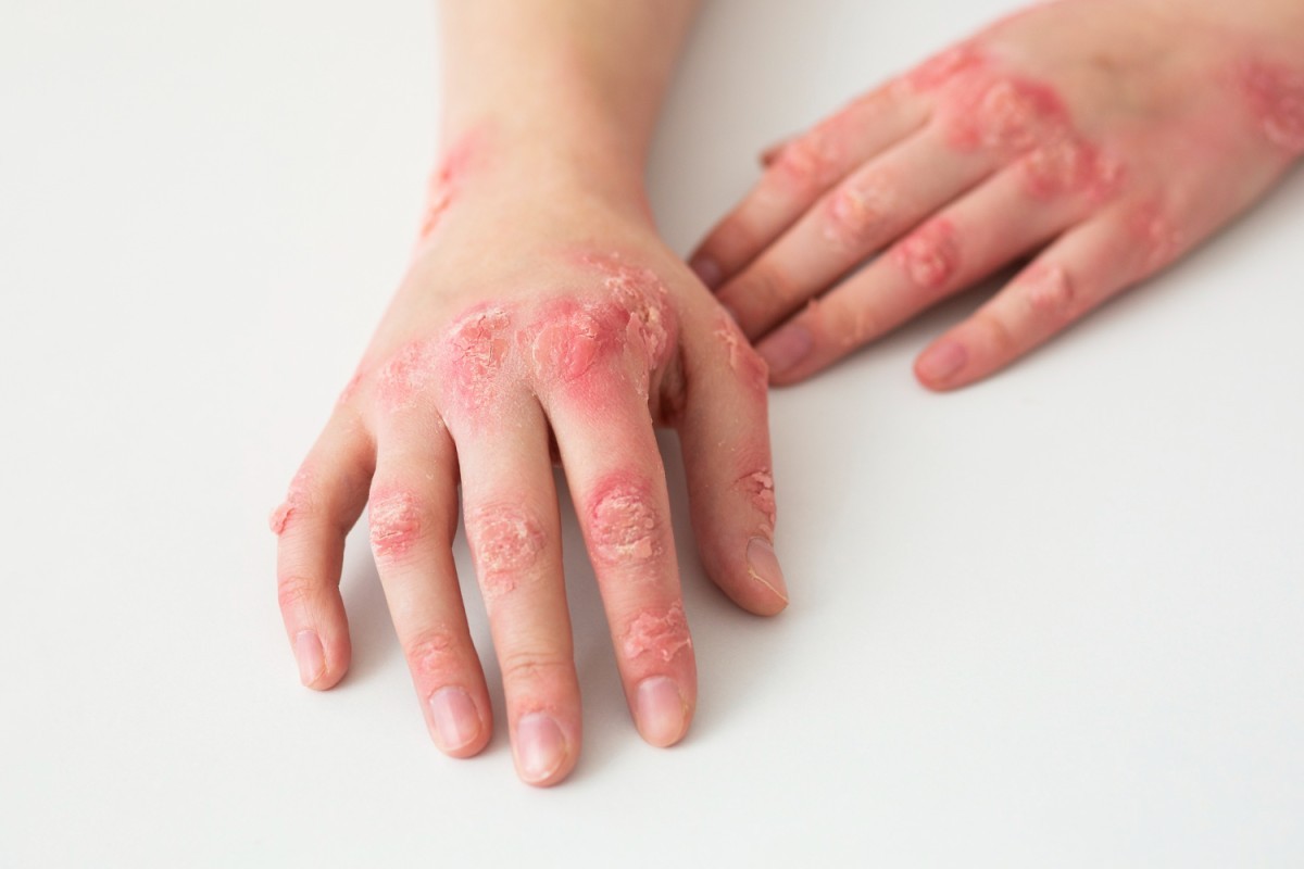 Dermatite Atópica no Outono: Fatores que Agravam a Doença e Como Prevenir